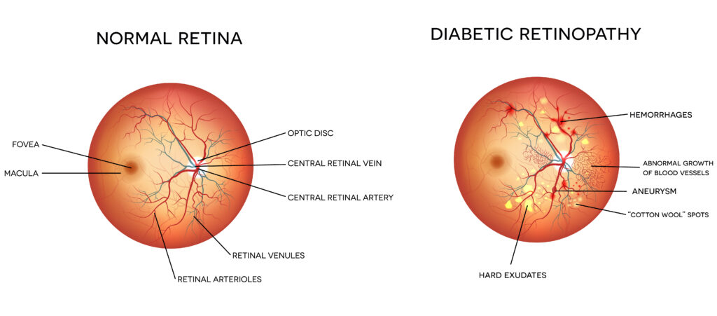 Diabetic retinopathy and normal eye retina.