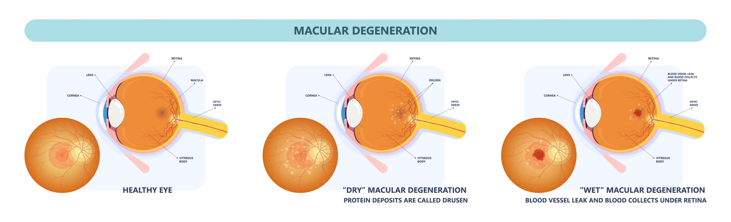 Macular Degeneration Pensacola | Eye Conditions Gulf Breeze, FL