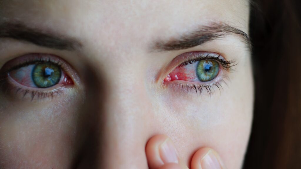 a woman's red irritated eye